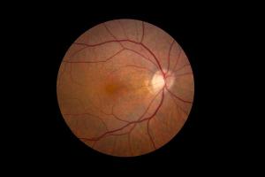 Retina showing reticular pseudodrusen