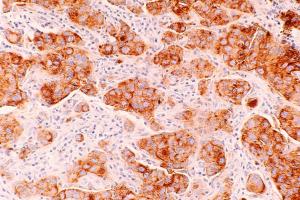breast cancer cells