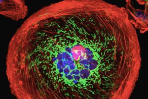 breast cancer cell